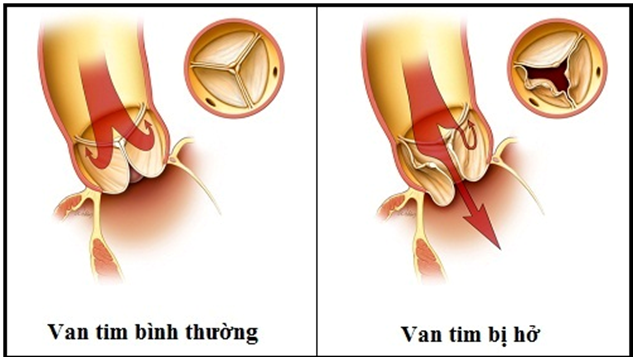 Hình ảnh minh họa van tim bị hở